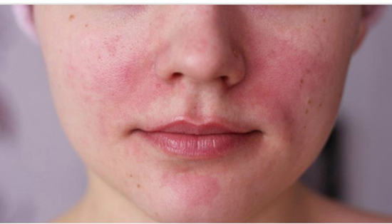 Причины и симптомы аллергии на IQOS