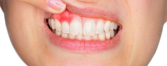 IQOS – причины, вызывающие боль в деснах и зубах. Способы решения проблемы, профилактика